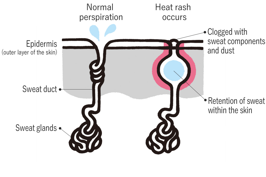 Heat rash mechanism