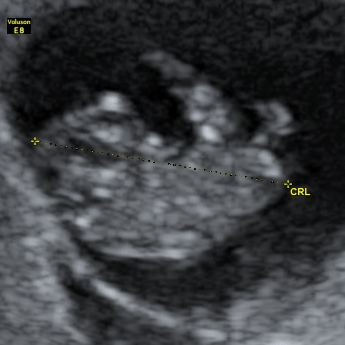 妊娠3ヶ月 妊娠8週 9週 10週 11週 の胎児と母体の状態 おむつのムーニー 公式 ユニ チャーム