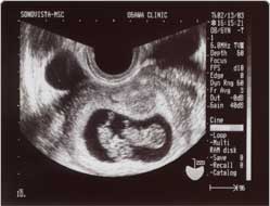 妊娠における超音波検査(エコー検査)のホントの目的とは？-おむつの