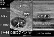 妊娠初期の超音波検査 おむつのムーニー 公式 ユニ チャーム
