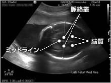 妊娠中期 後期の超音波検査 妊娠中の検査シリーズ おむつの
