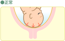 子宮 頸管 無力 症 症状