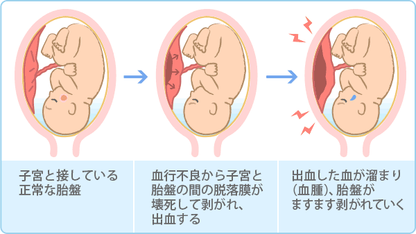 常位胎盤早期剥離とは 症状や兆候 原因は おむつのムーニー 公式 ユニ チャーム