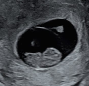 目 10 エコー 週 妊娠10週0日(10w0d)の超音波(エコー)写真