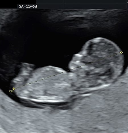妊娠11週 胎児の様子は 母体の状態は おむつのムーニー 公式 ユニ チャーム