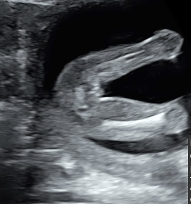 妊娠17週目 女の子の性別もわかる おむつのムーニー 公式 ユニ チャーム