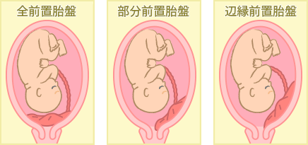 前置胎盤とは 原因や治し方は おむつのムーニー 公式 ユニ チャーム